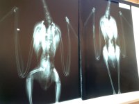 Radiografías de una garza real tiroteada. En la de la izquierda se aprecia el perdigón en el ala, cuyo cúbito está fracturado; en la de la derecha, el hueso roto está ya osificado.