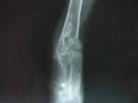 Fractura MMII con metralla