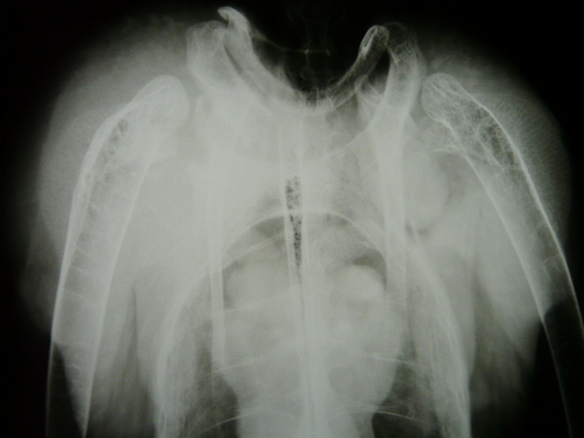 Radiografía de la avutarda donde se aprecia la fractura coracoides